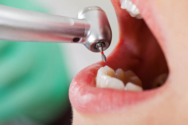 Best Emergency Treatment for Dental Infections or Abscesses in High Rolls, NM